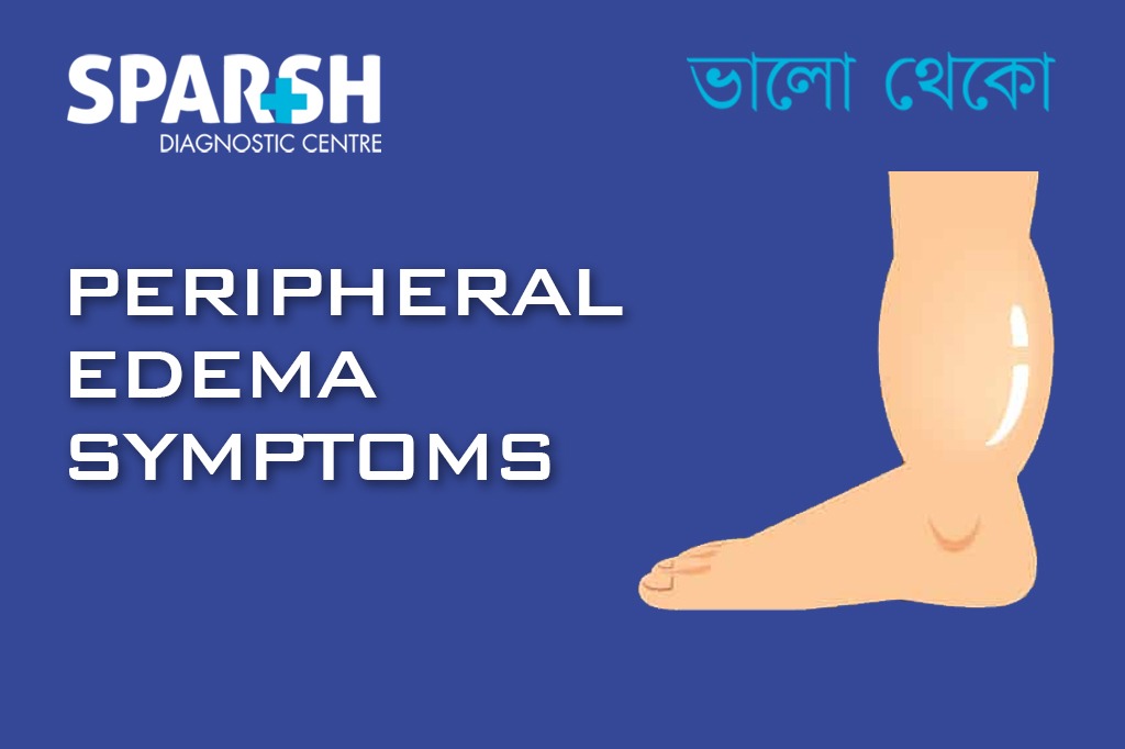 Peripheral Edema