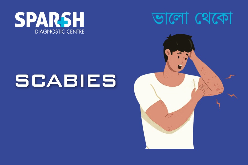 Scabies