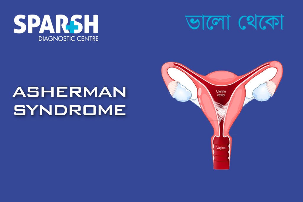 Asherman Syndrome