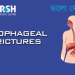 Esophageal Strictures