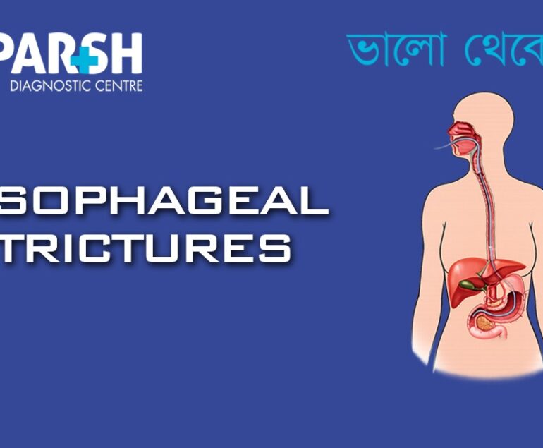 Esophageal Strictures