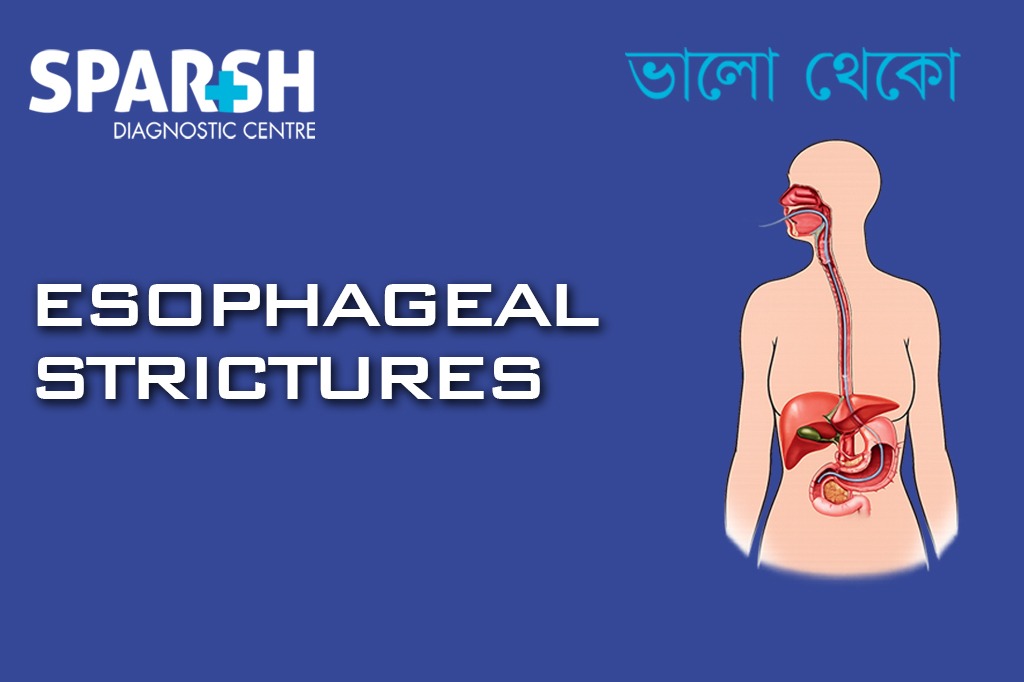 Esophageal Strictures