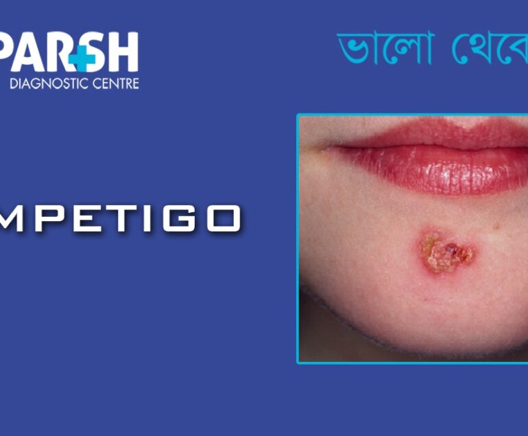 Impetigo