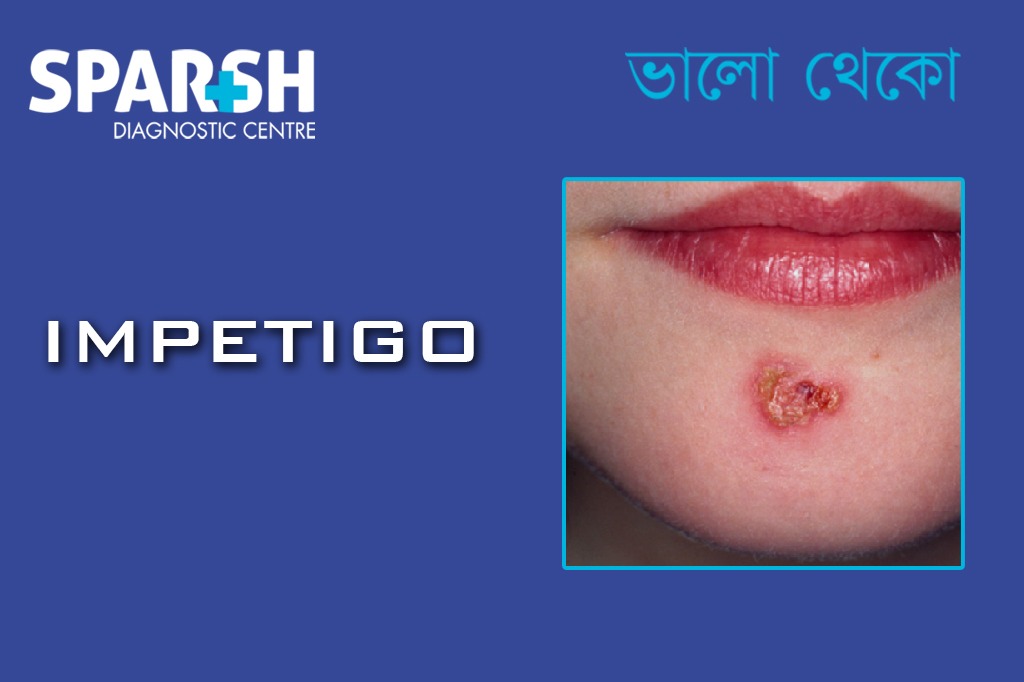 Impetigo