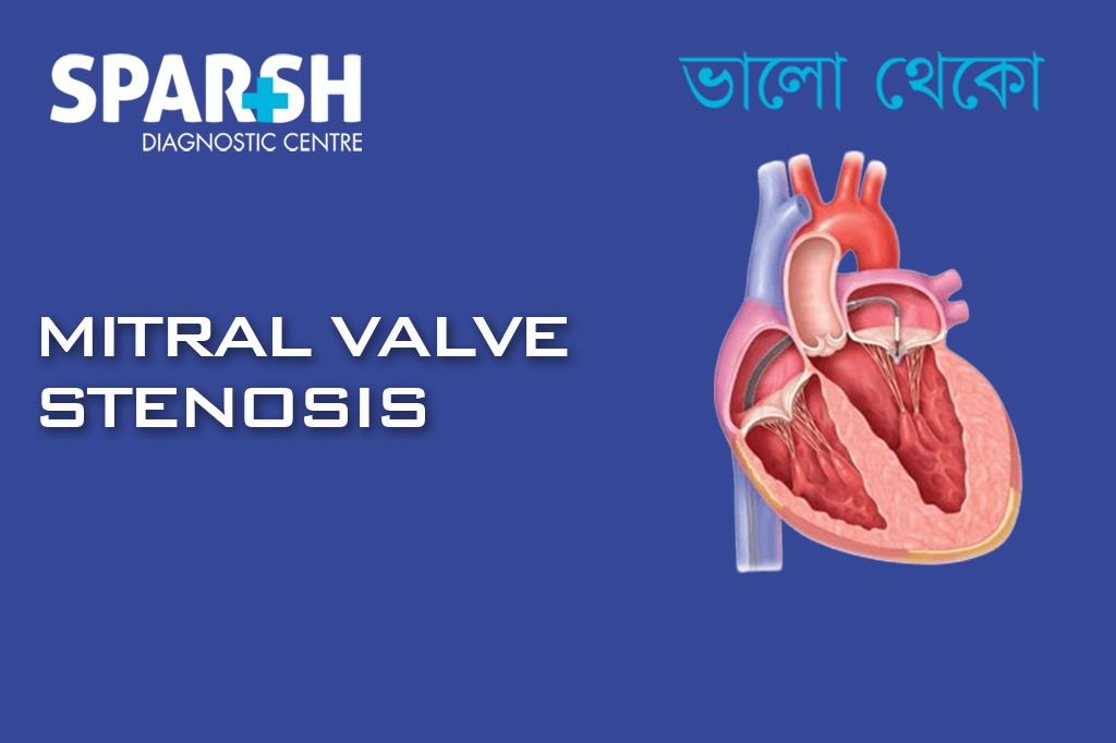 Mitral Valve Stenosis CP