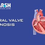 Mitral Valve Stenosis