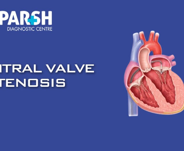 Mitral Valve Stenosis
