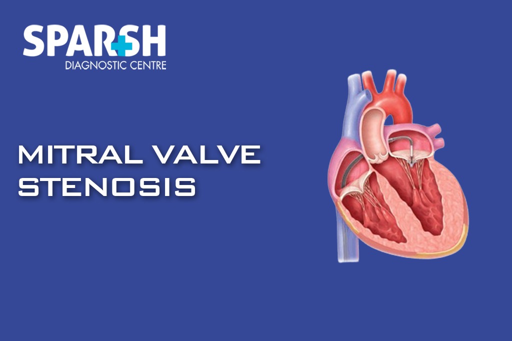 Mitral Valve Stenosis