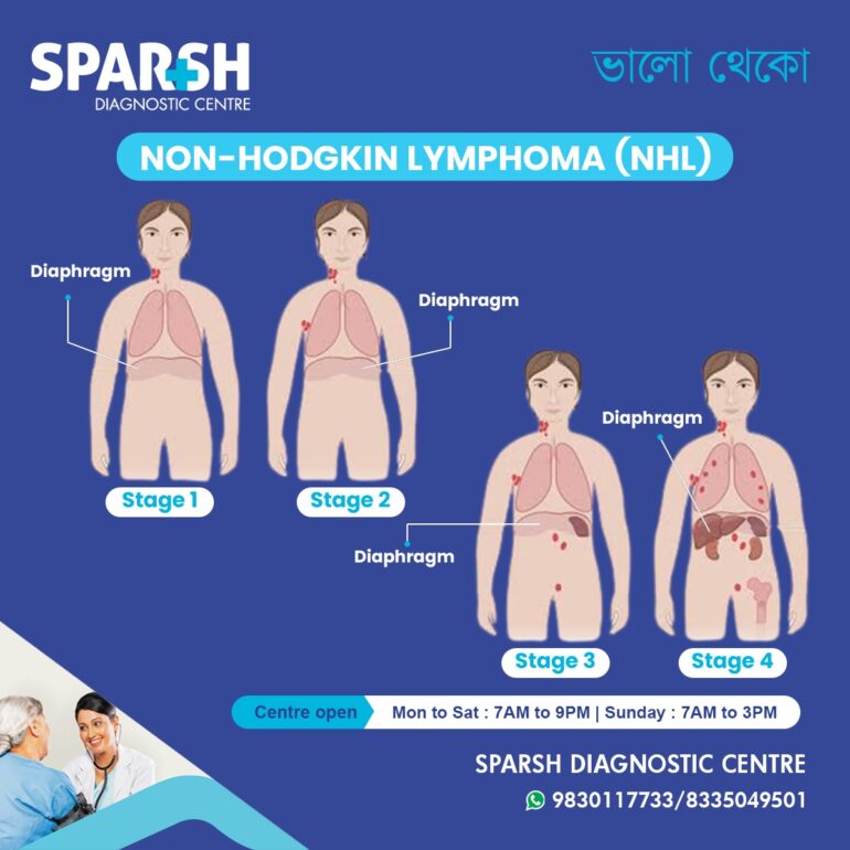 Non-Hodgkin Lymphoma (NHL): Symptoms, Causes, Stages, Diagnosis ...