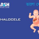 Omphalocele CP