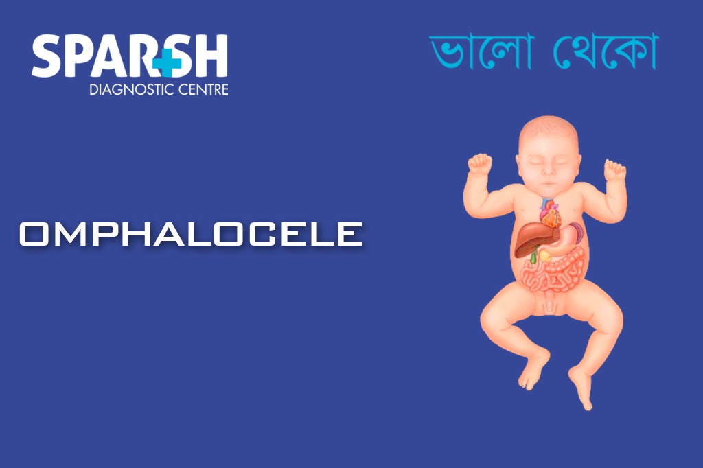 Omphalocele CP