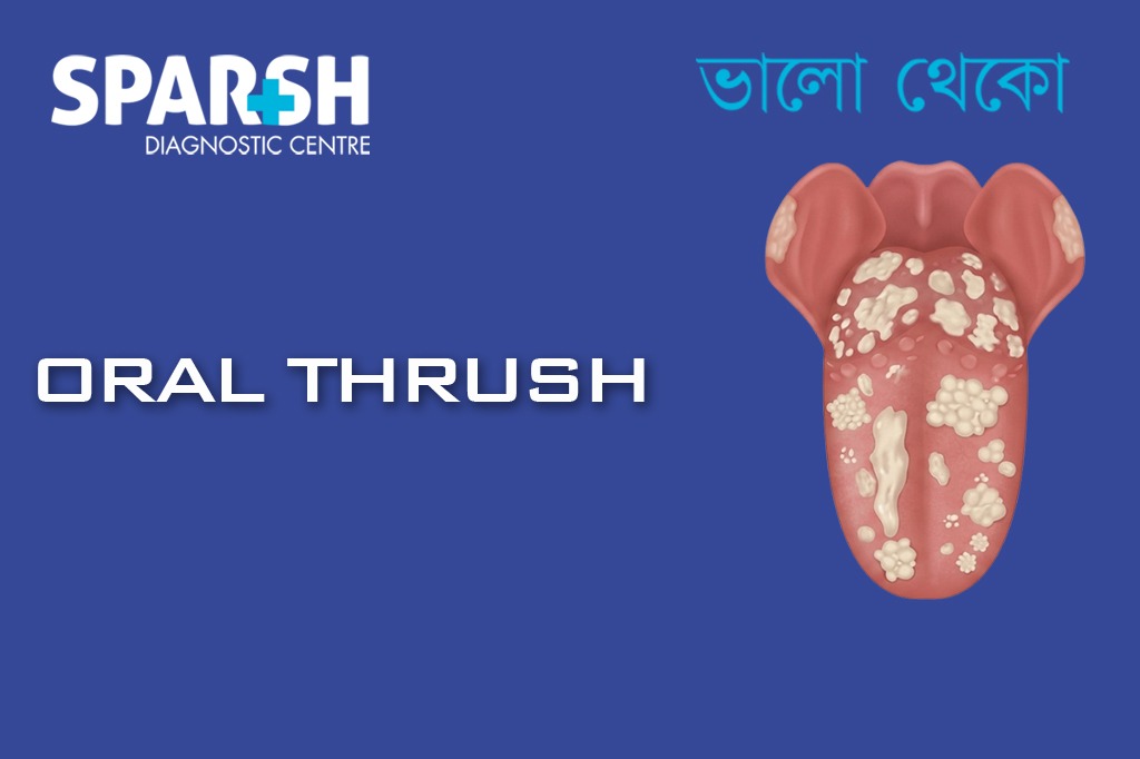 Oral Thrush CP