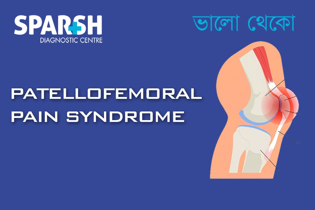 Patellofemoral Pain Syndrome