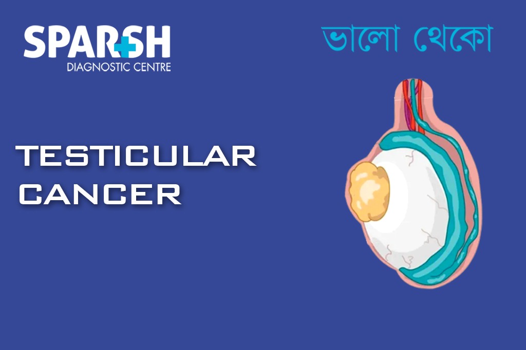 Testicular Cancer