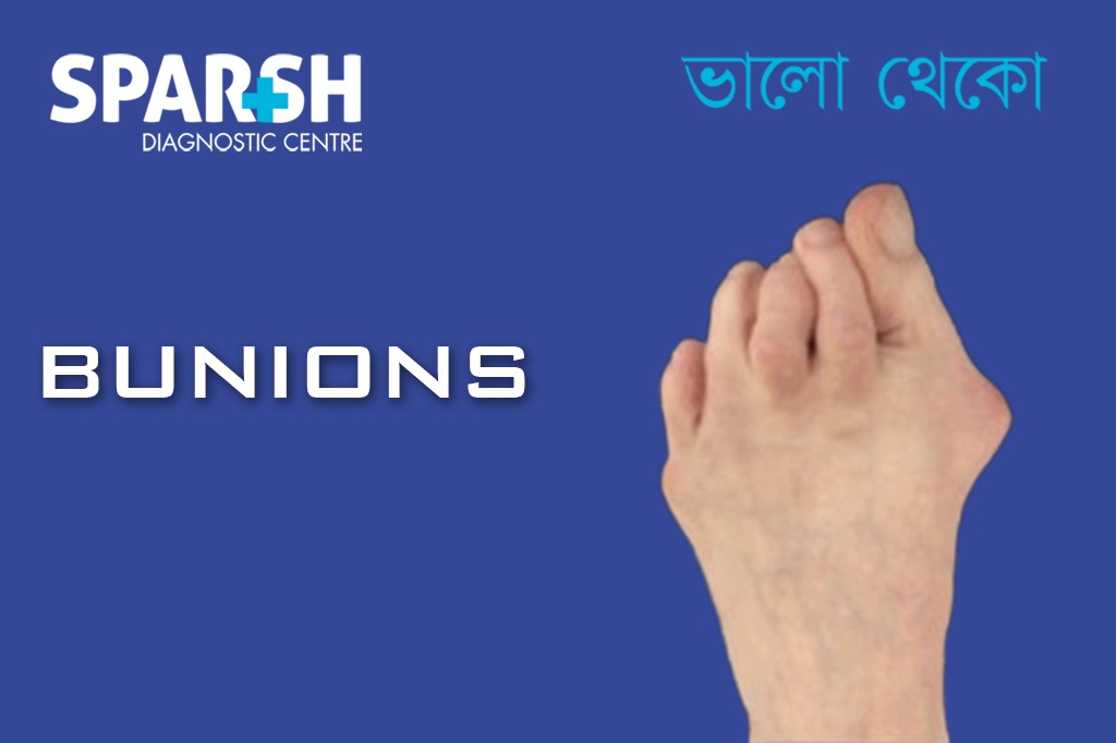 Bunions