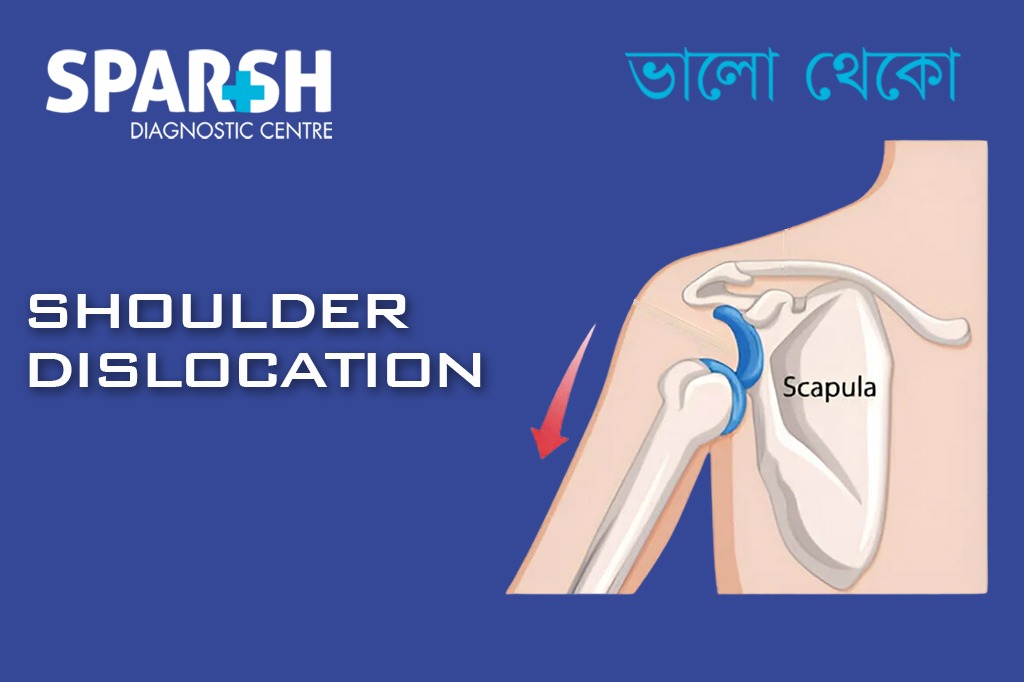 Dislocated Shoulder CP