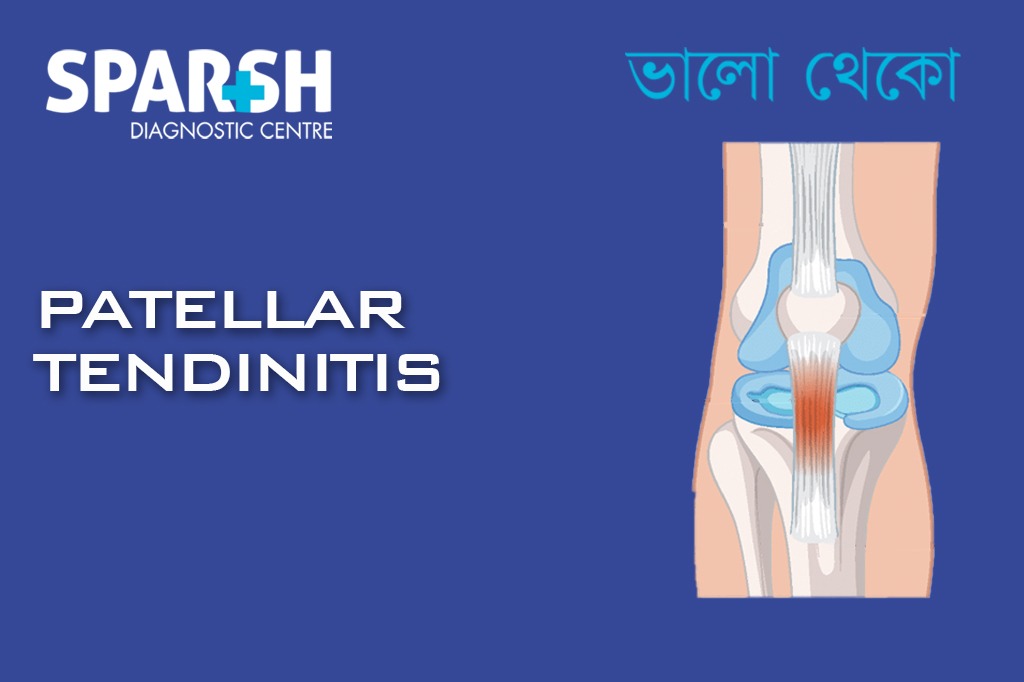 Patellar Tendinitis