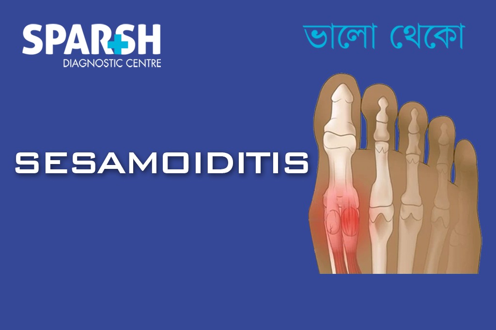 Sesamoiditis CP