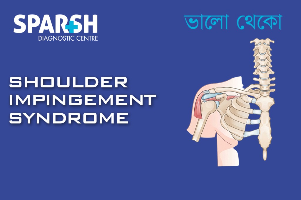 Shoulder Impingement Syndrome CP