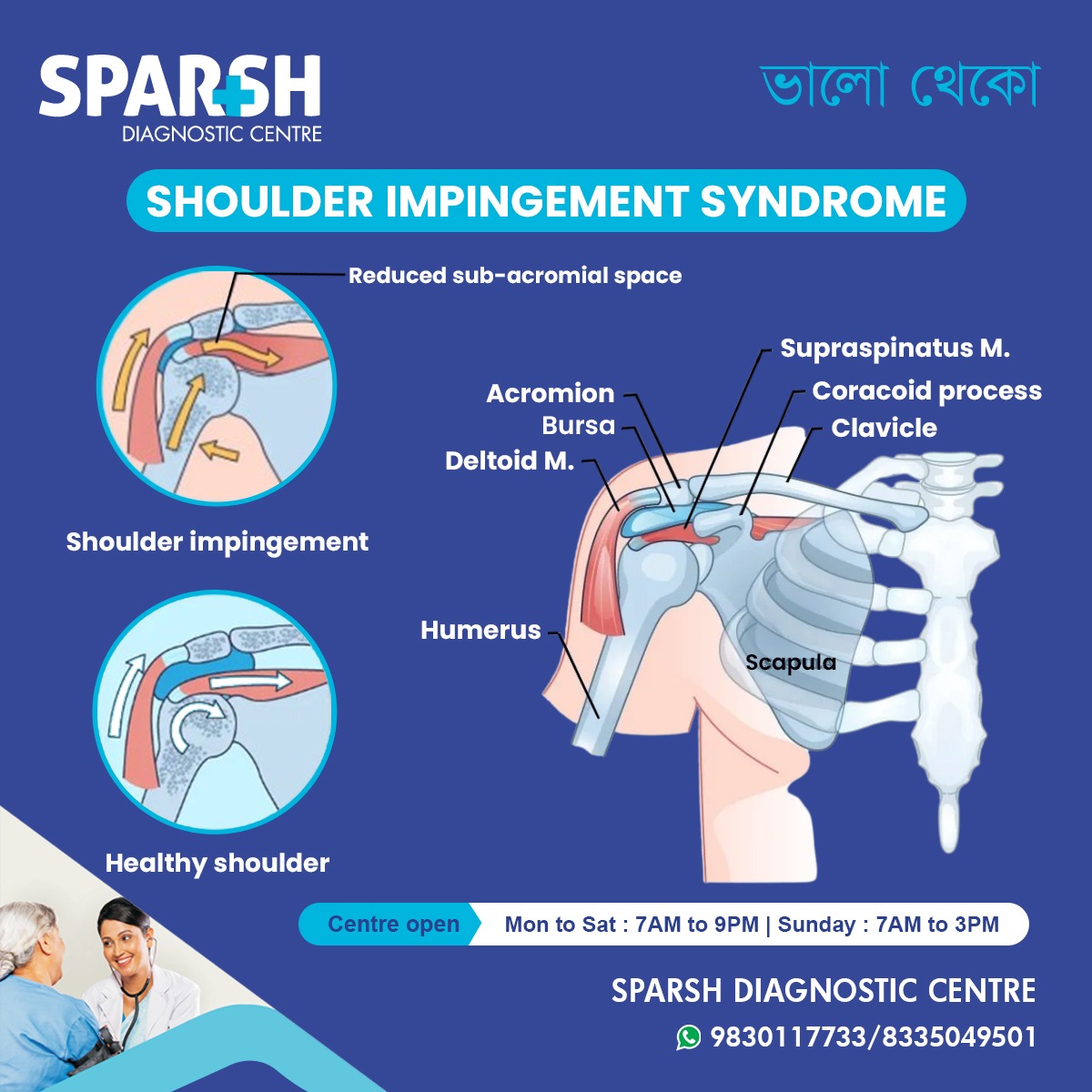 Shoulder Impingement Syndrome