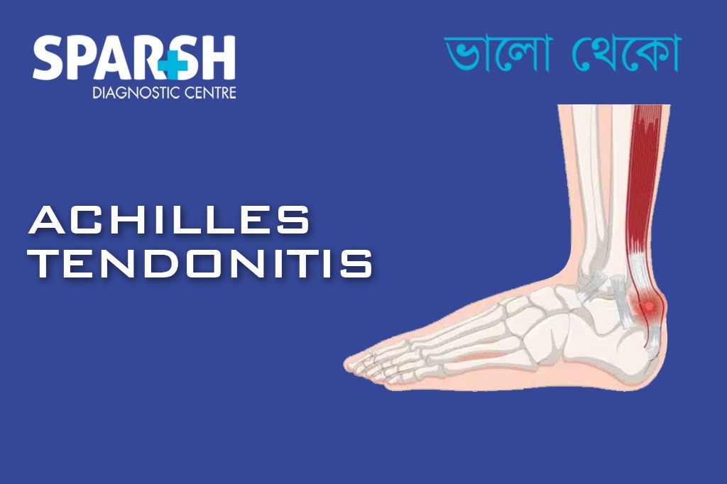 Achilles Tendonitis