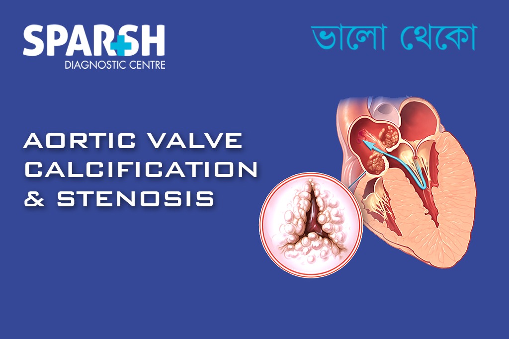 Aortic Valve Calcification Stenosis