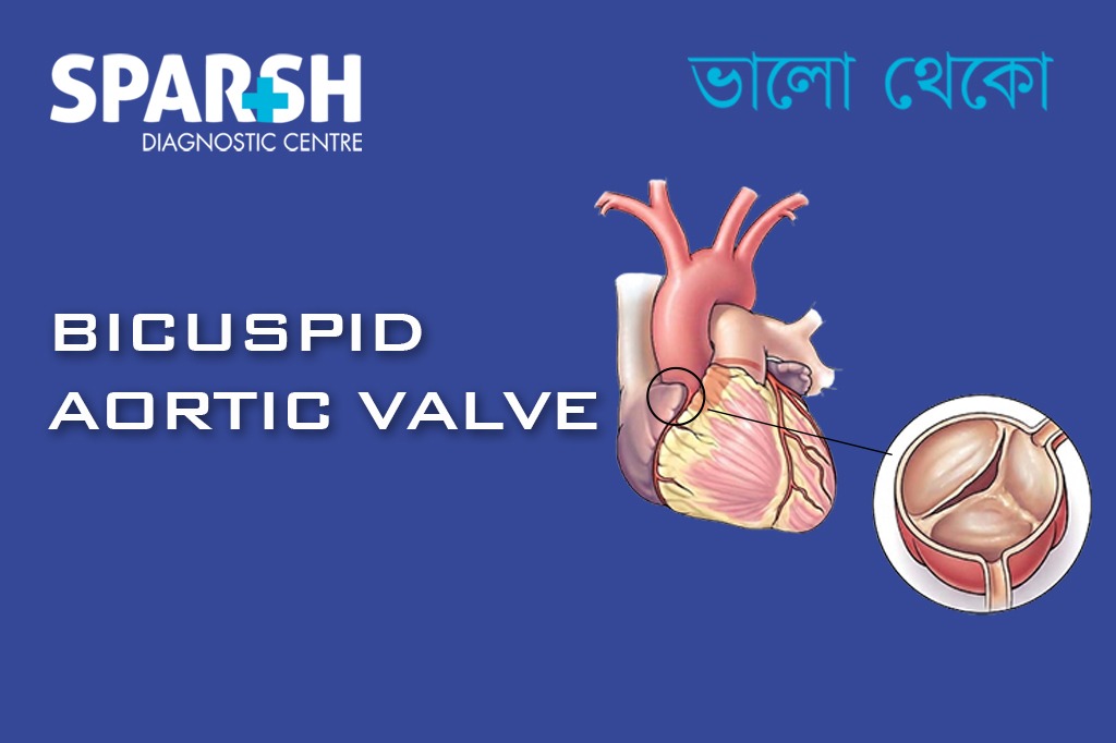 Bicuspid Aortic Valve