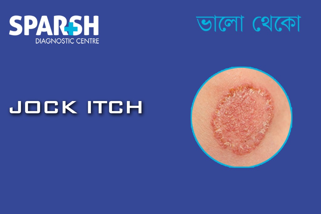Jock Itch CP