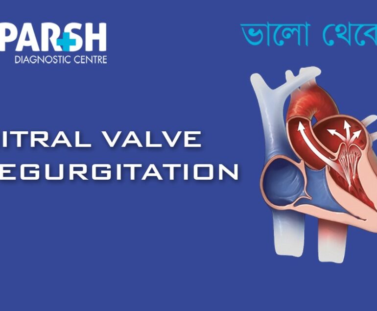 Mitral Valve Regurgitation