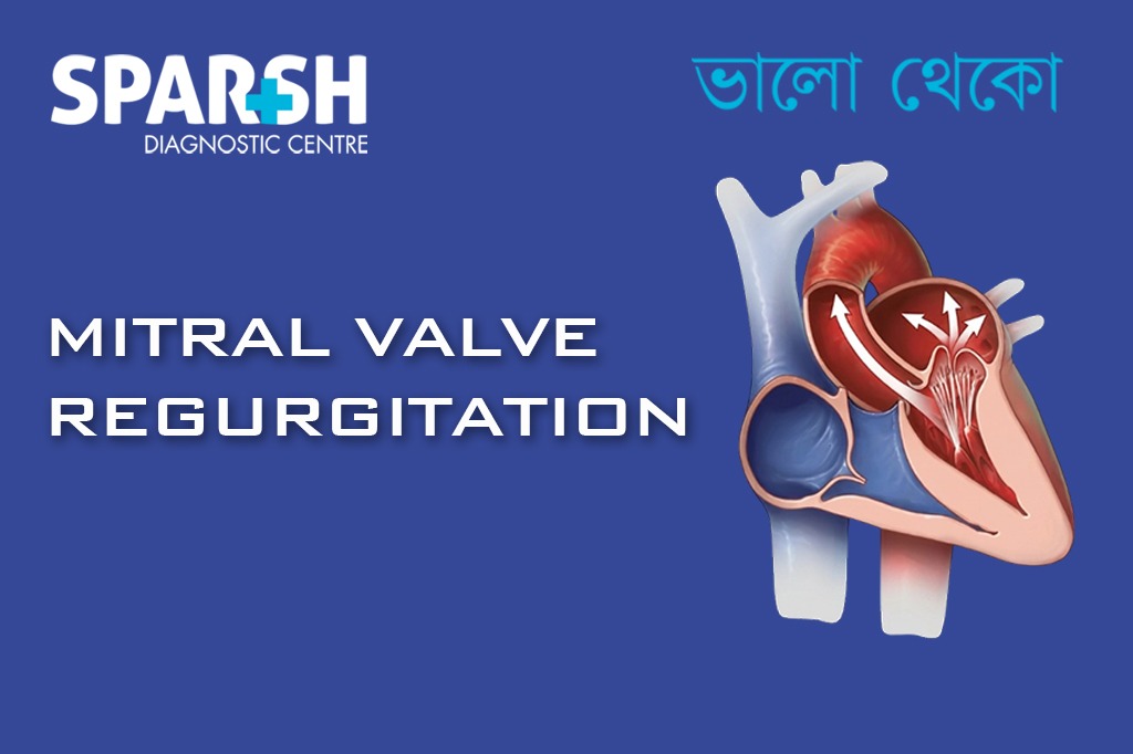 Mitral Valve Regurgitation