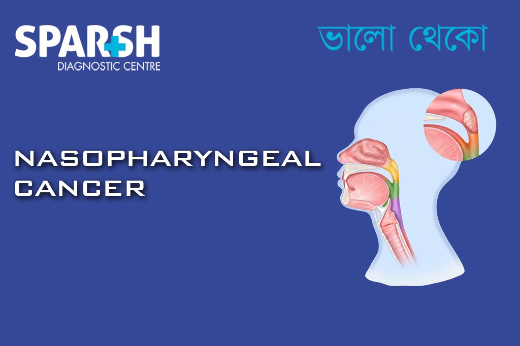 Nasopharyngeal Cancer