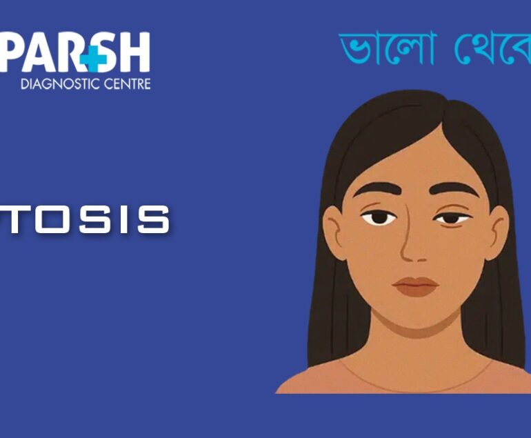 Ptosis
