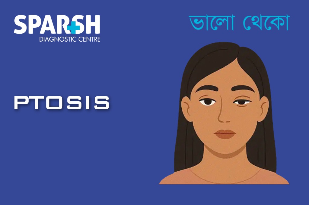 Ptosis