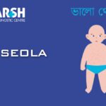 Roseola