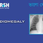 Cardiomegaly
