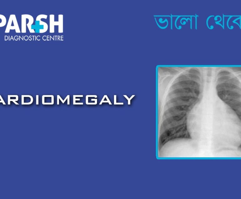 Cardiomegaly