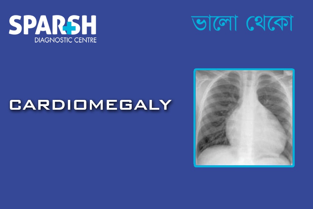 Cardiomegaly