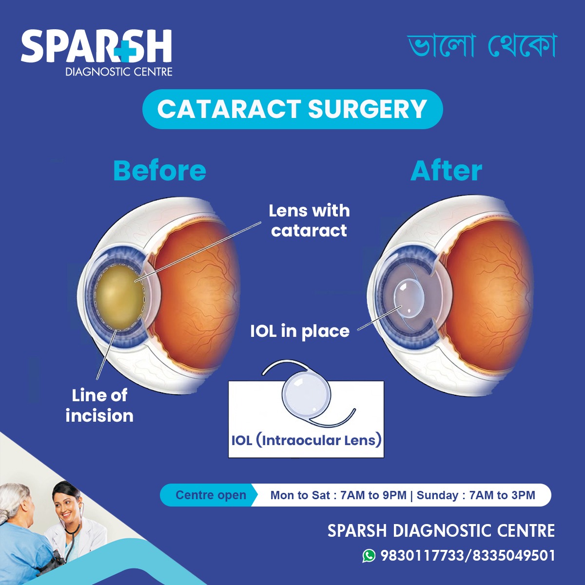 Cataract Surgery