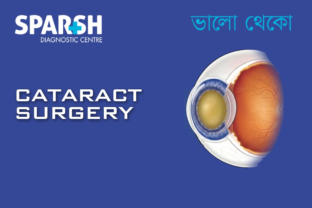 Cataract Surgery