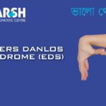 Ehlers Danlos Syndrome EDS