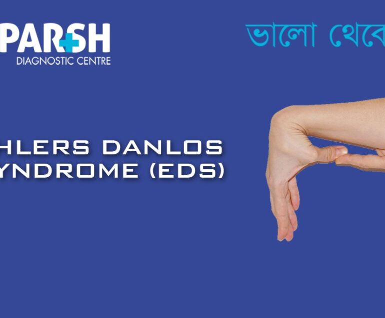 Ehlers Danlos Syndrome EDS