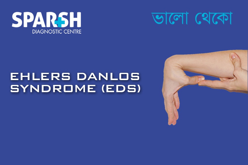 Ehlers Danlos Syndrome EDS