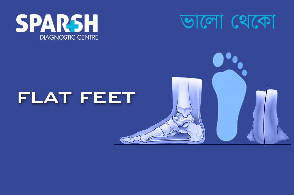 Flat Feet CP