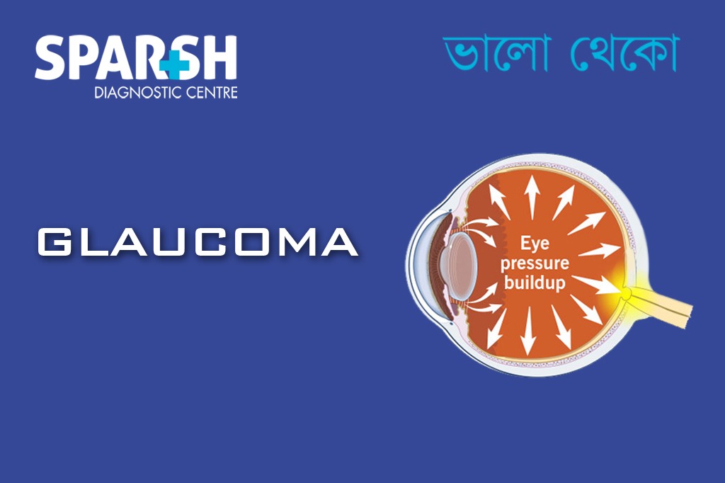 Glaucoma CP