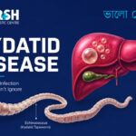 Hydatid Disease