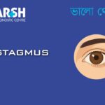 Nystagmus