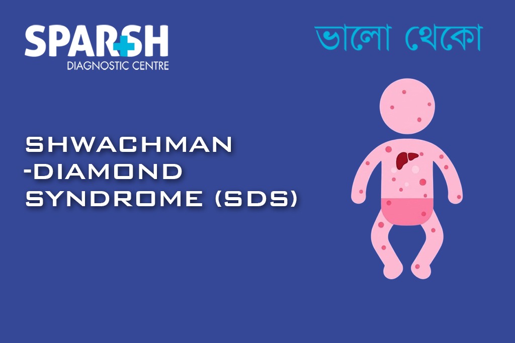 Swachman Diamond Syndrome SDS