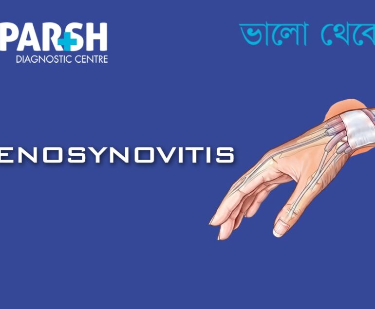 Tenosynovitis