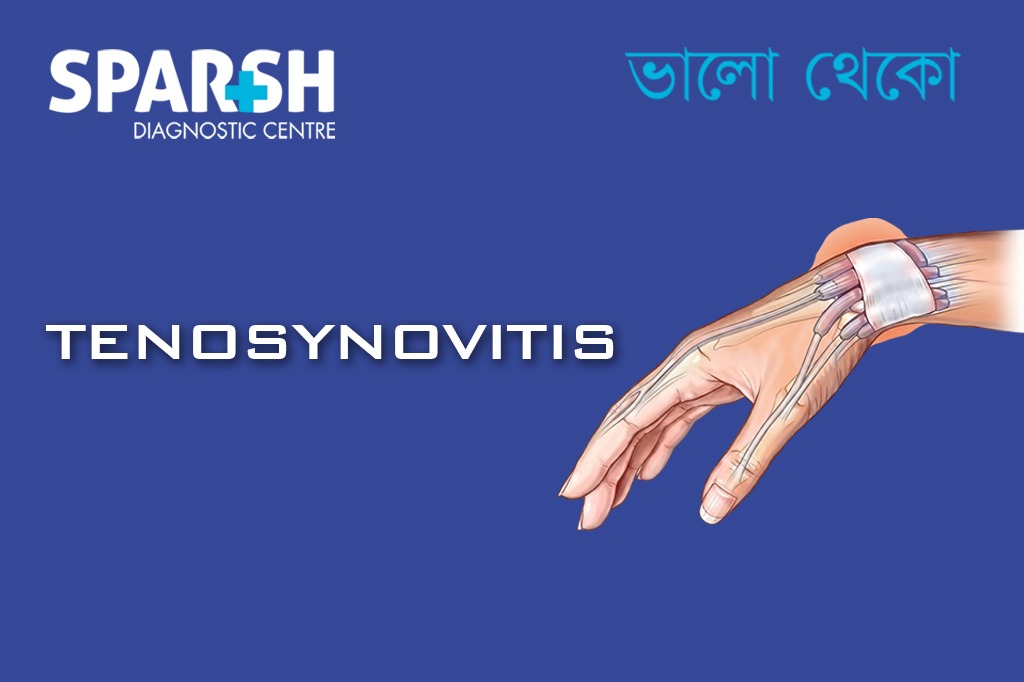 Tenosynovitis