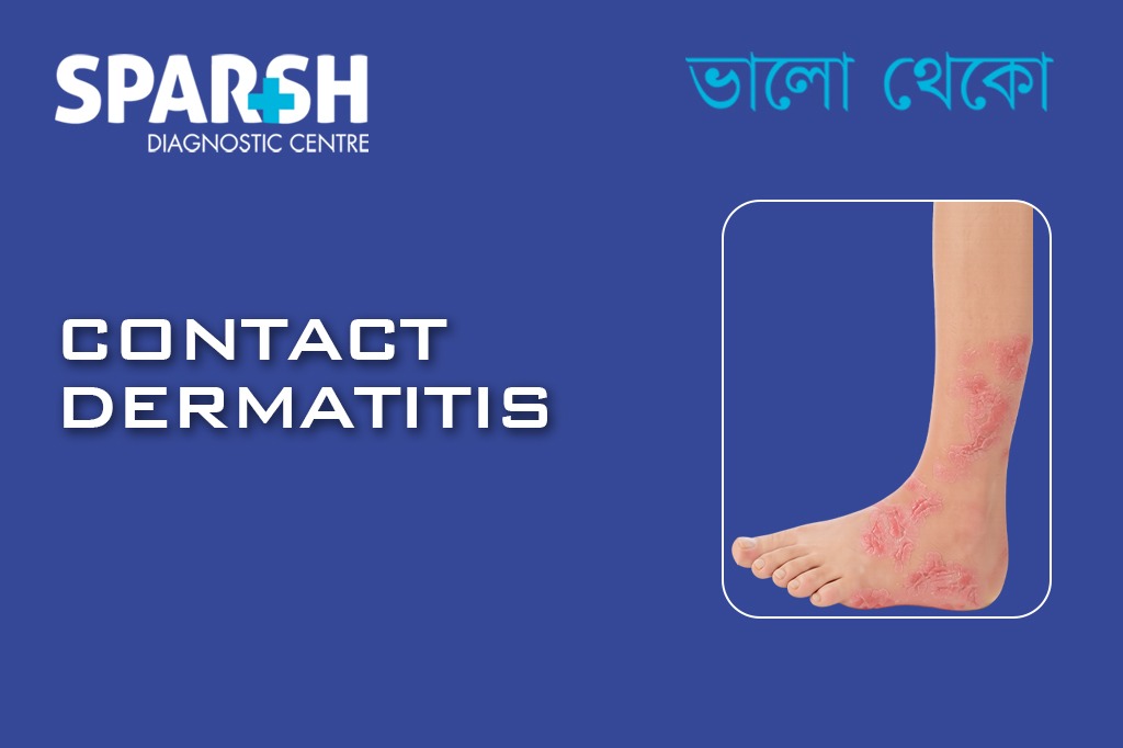 Contact Dermatitis